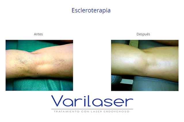 VARICES QUITO