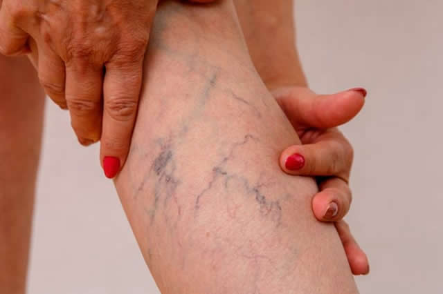 CIRUJANO VASCULAR EN QUITO