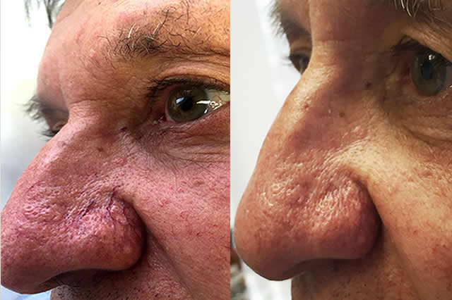 HIPERHIDROSIS EN QUITO